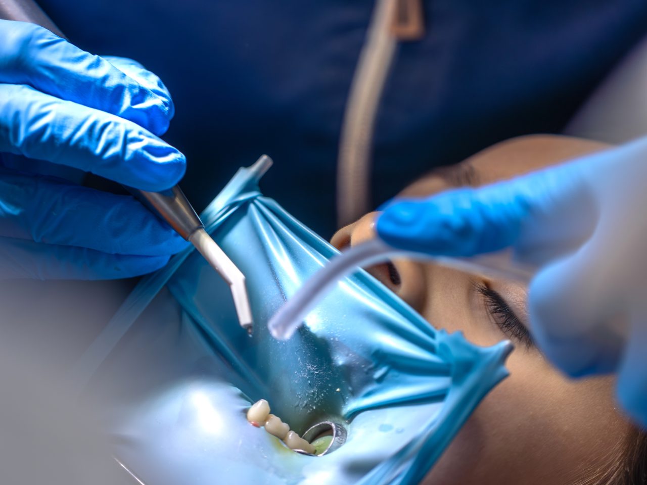Paciente está com três dentes em isolamento, e dentista está realizando procedimento neles.