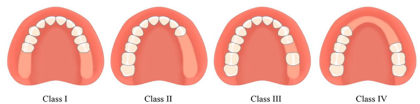 Imagem de quatro arcadas dentárias, mostrando as 4 classificação de Kennedy.