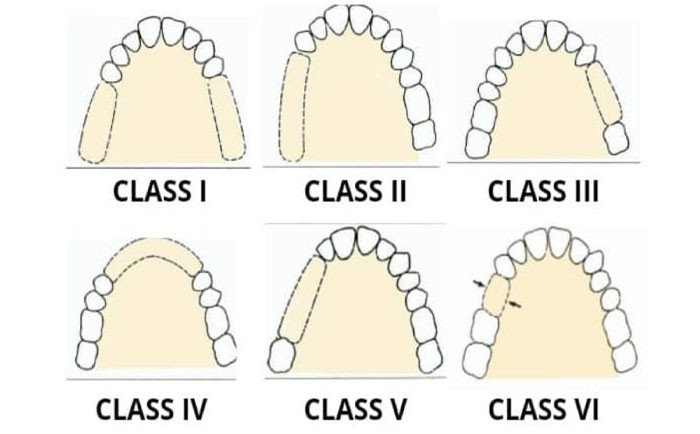Imagem de seis arcadas dentárias, mostrando as 4 classes de Kennedy e 2 complementações de Applegate.