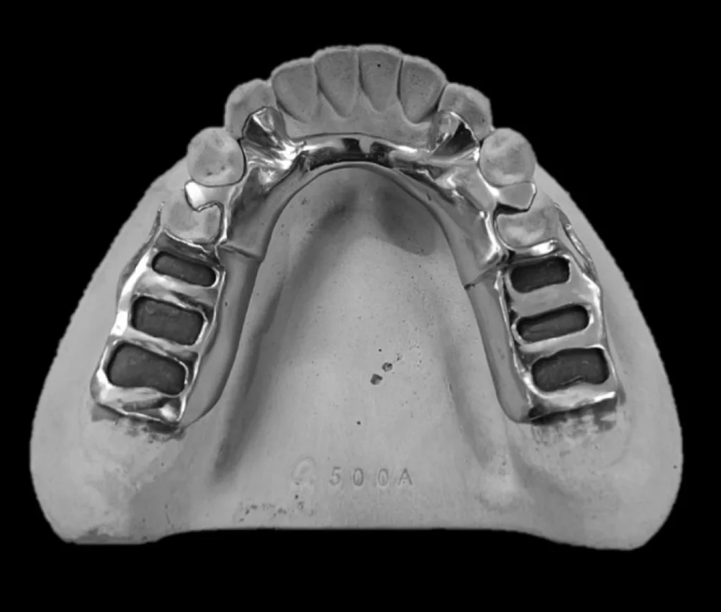 Arcada dentária feita de gesso estão faltando alguns dentes, por cima tem uma prótese metálica de onde os dentes novos serão colocados.
