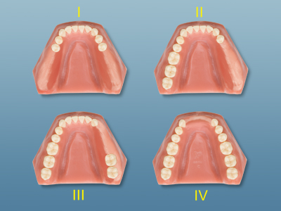 Imagem de quatro arcadas dentárias, mostrando as 4 classes de Kennedy.
