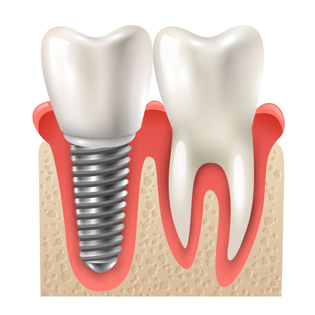 Desenho de dente normal e dente de implante.