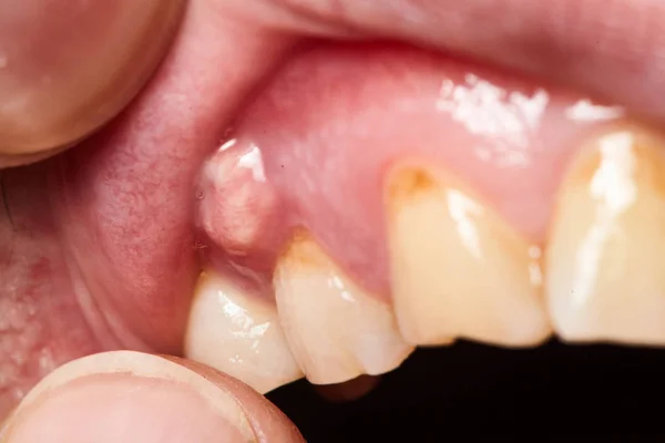 Boca com abscesso dental.