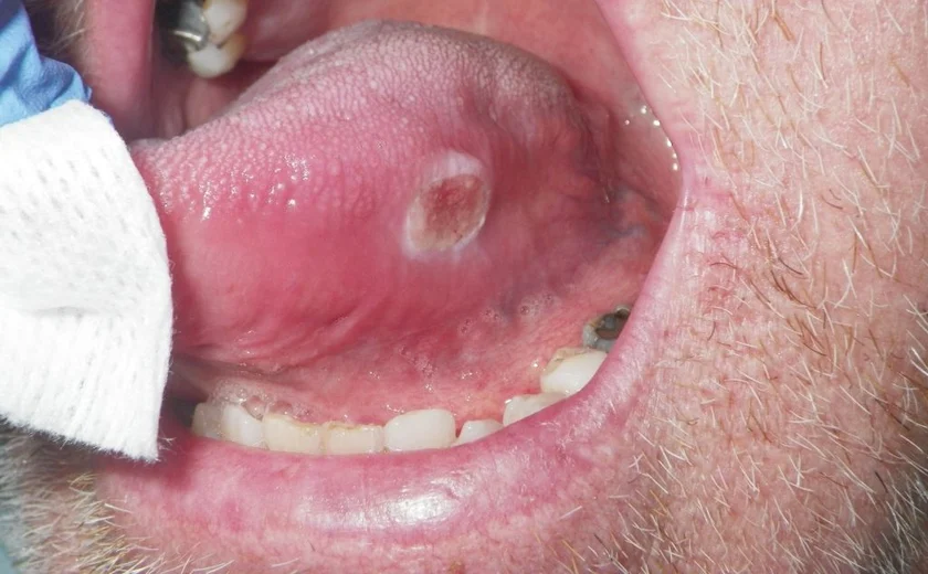 Paciente com lesão de câncer bucal.
