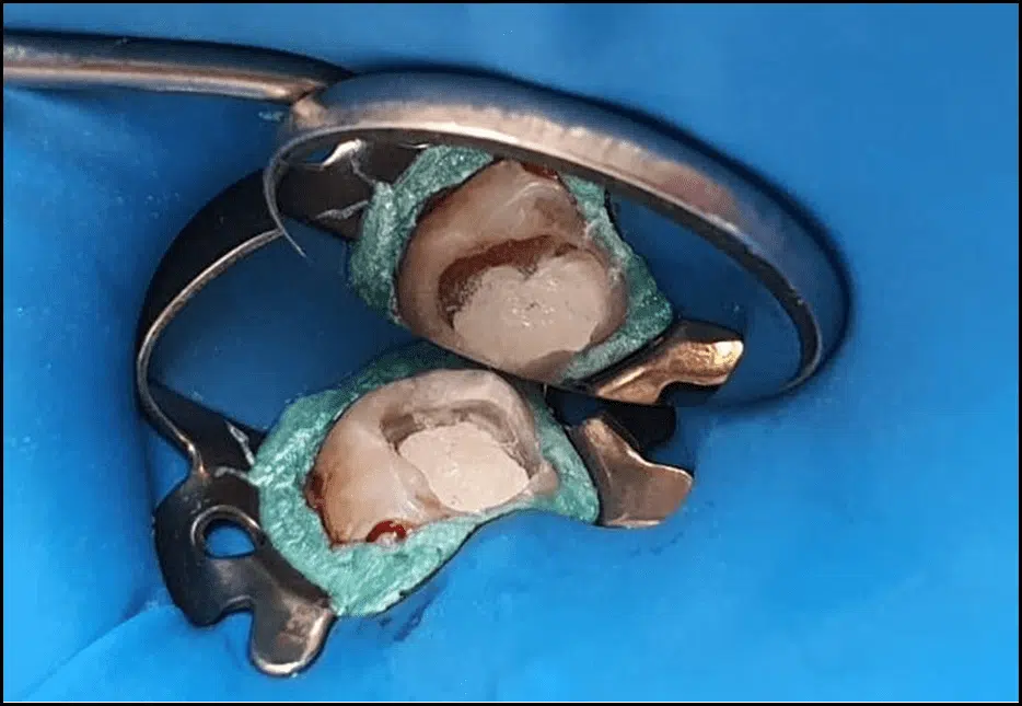 Capeamento Pulpar Direto após ser aplicado cimento biocerâmico;