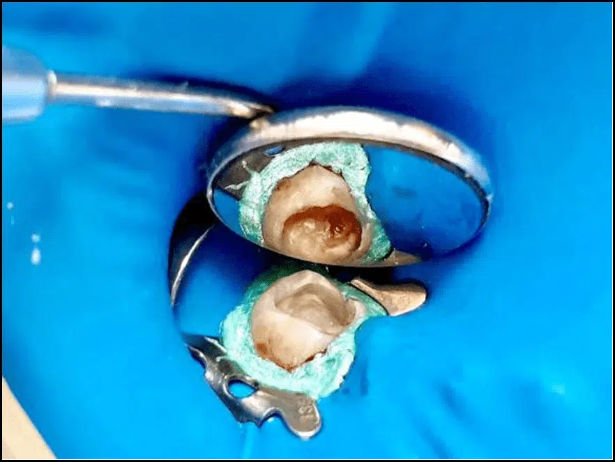 Capeamento Pulpar Direto