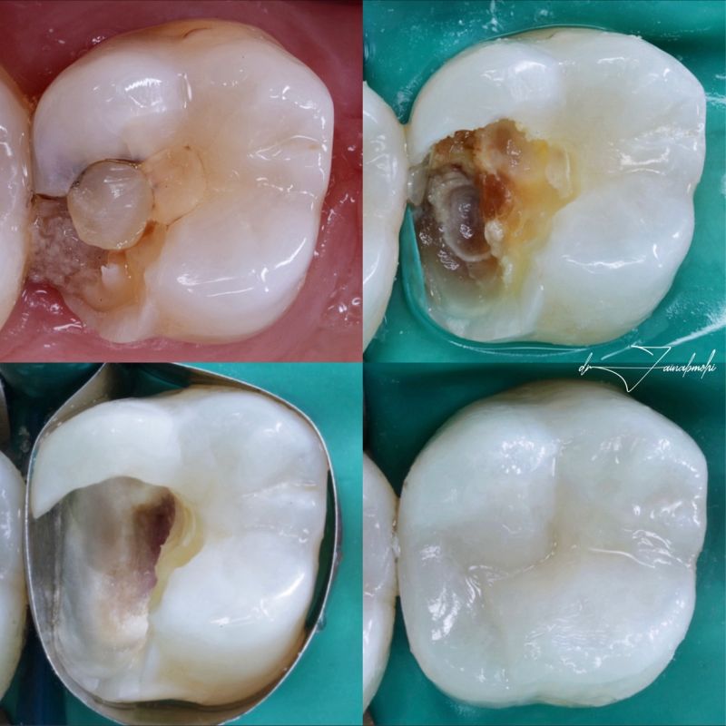 Imagens de Capeamento Pulpar Indireto antes e depois.