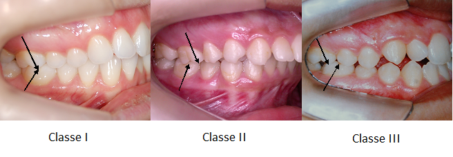 Setas apontam em bocas de pessoas com oclusões dos tipos Classe I, Classe II e Classe III de Angle