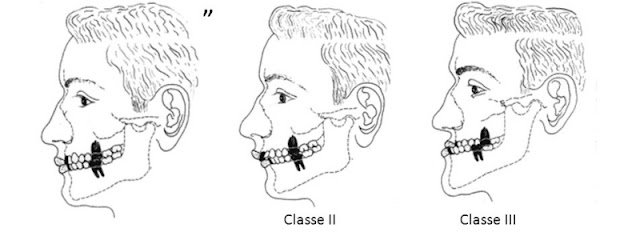 Desenhos mostram como é a Classificação de Angle, com 3 rostos com os tipos de oclusões das Classe I, Classe II e Classe III de Angle.