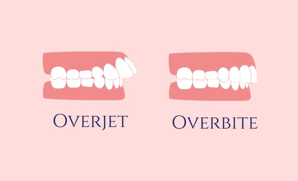 Desenho mostra diferença de overjet e overbite.