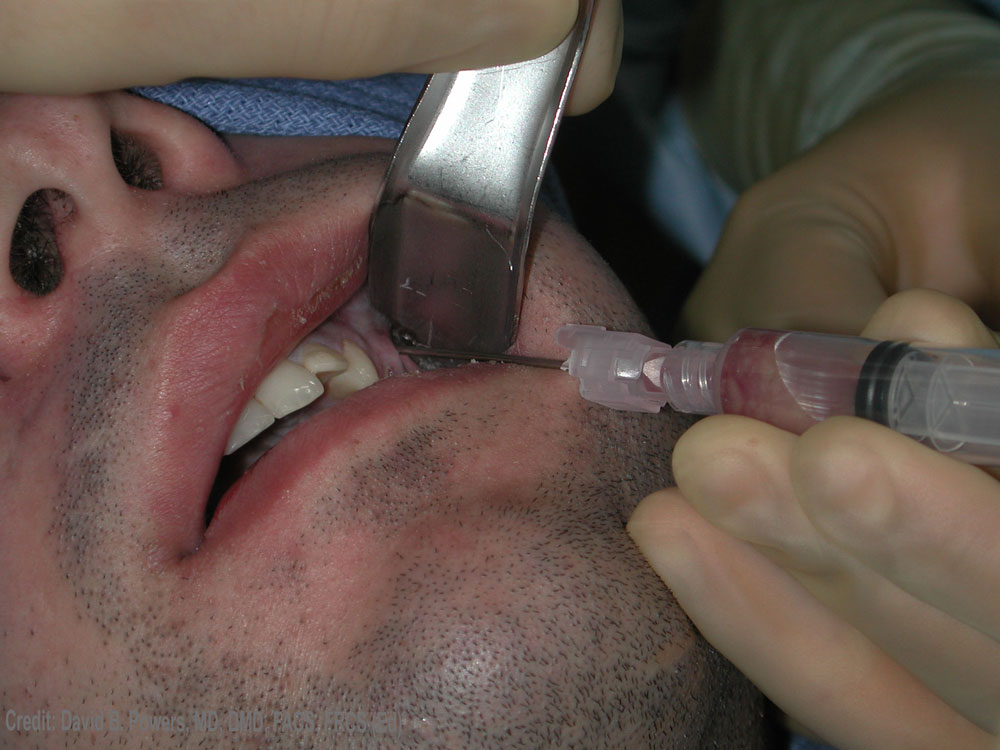 Dentista removendo abscesso dental de paciente com seringa.