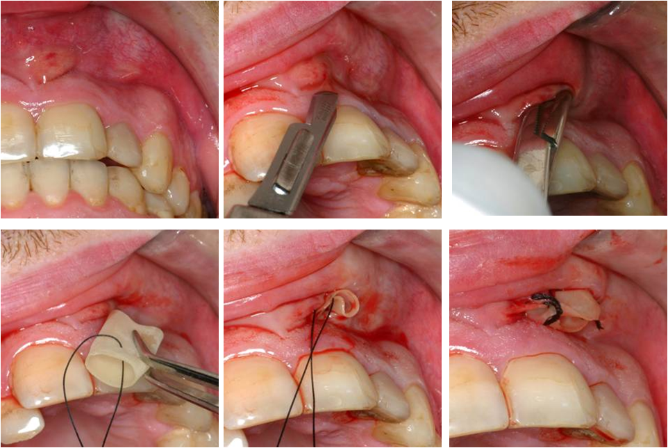 Passo-a-passo de drenagem de abscesso dental.