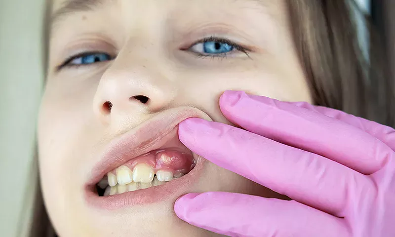 Dentista puxando lábio superior de menina para olhar abscesso dental.