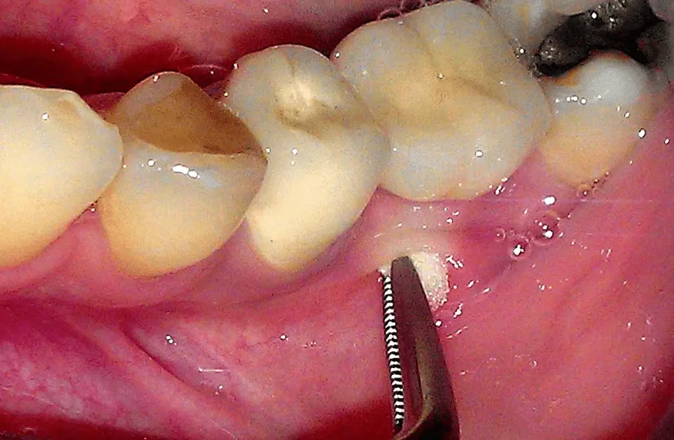 Dentista removendo abscesso dental de paciente;