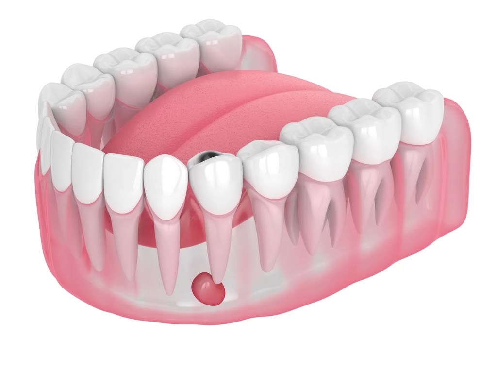 Desenho digital de boca com abscesso dental embaixo do dente.
