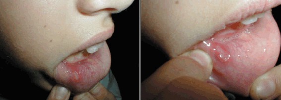 Garoto com afta recorrente.