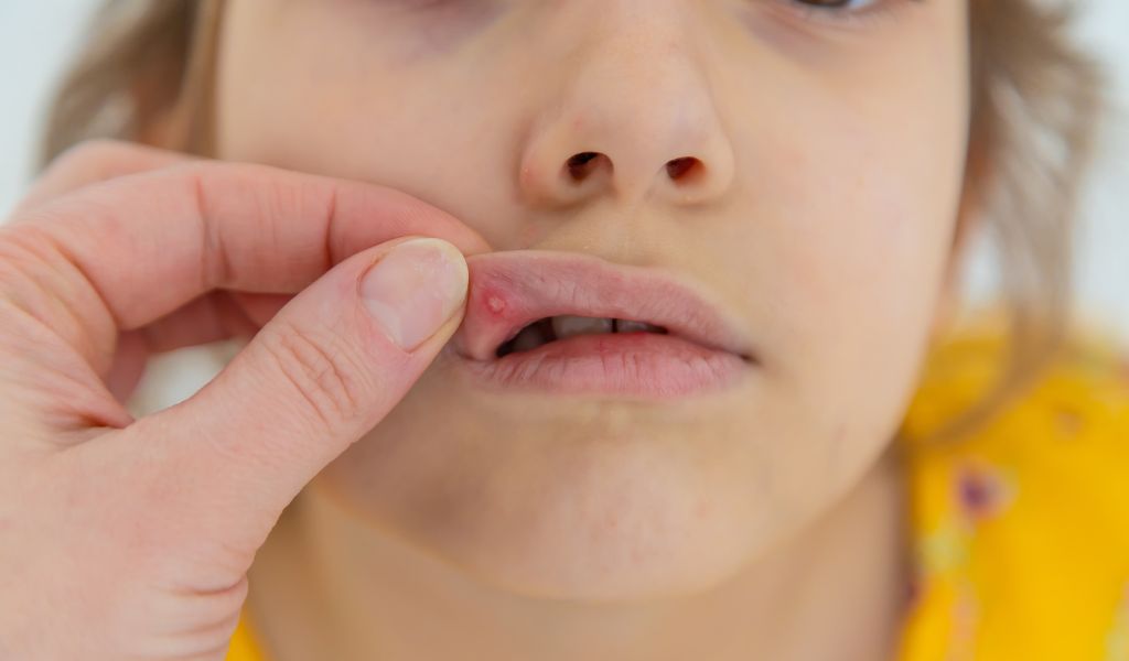 Mostrando afta em boca de criança