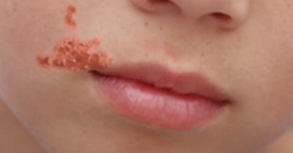 Garotinho com impetigo na boca