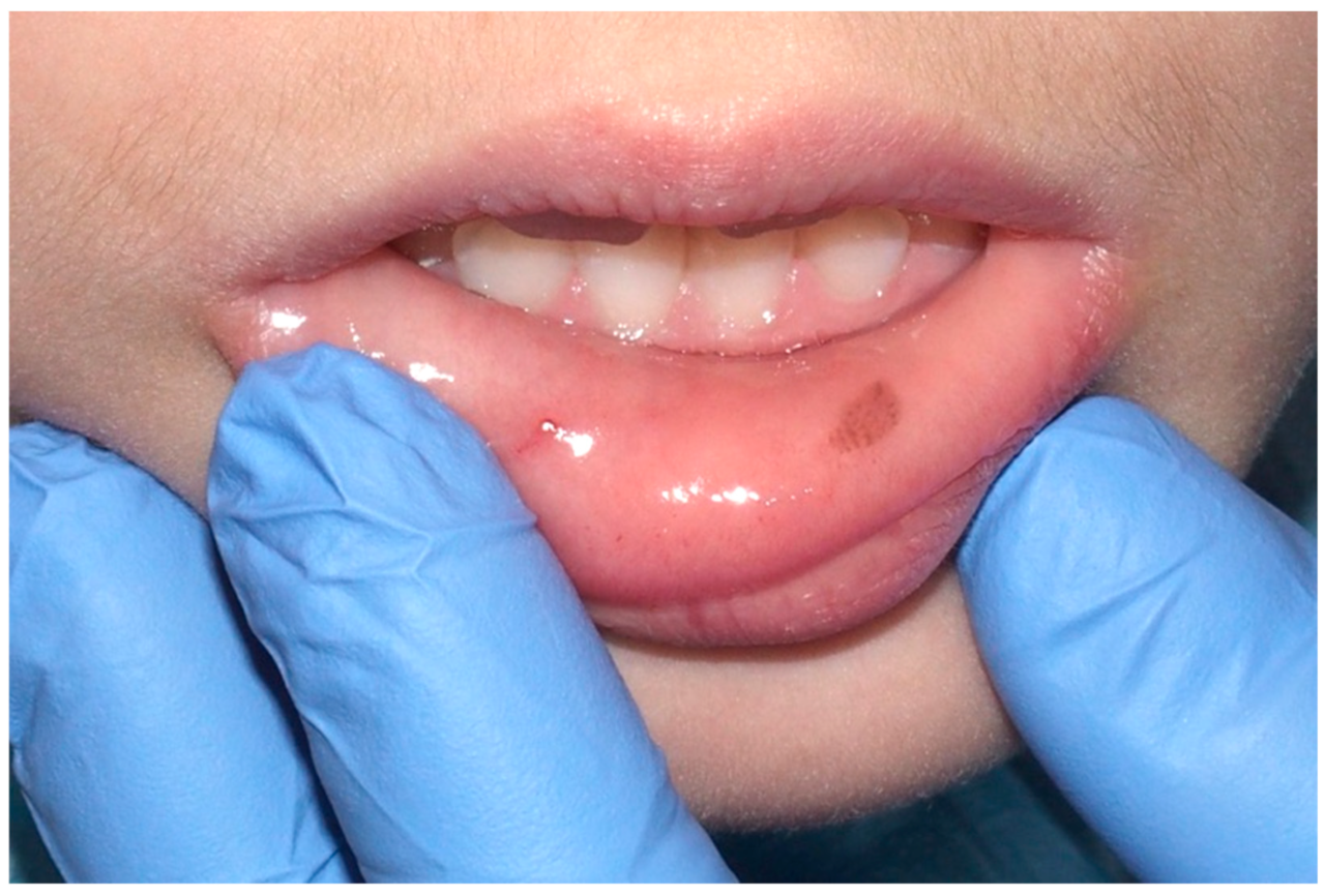 Dentista com luva está mostrando na boca de paciente criança uma mancha de mácula melanótica.
