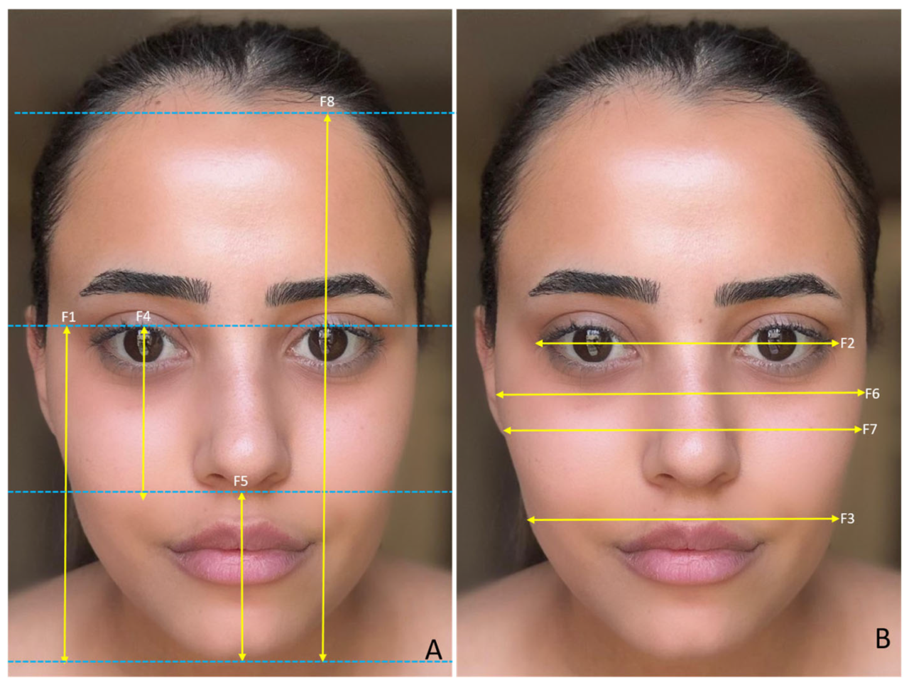 Imagem mostra diferentes marcações que precisam ser considerados em rosto de paciente para saber se está alinhado ao fazer harmonização.