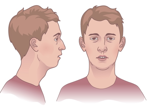 Desenho de garoto com síndrome do respirador bucal.