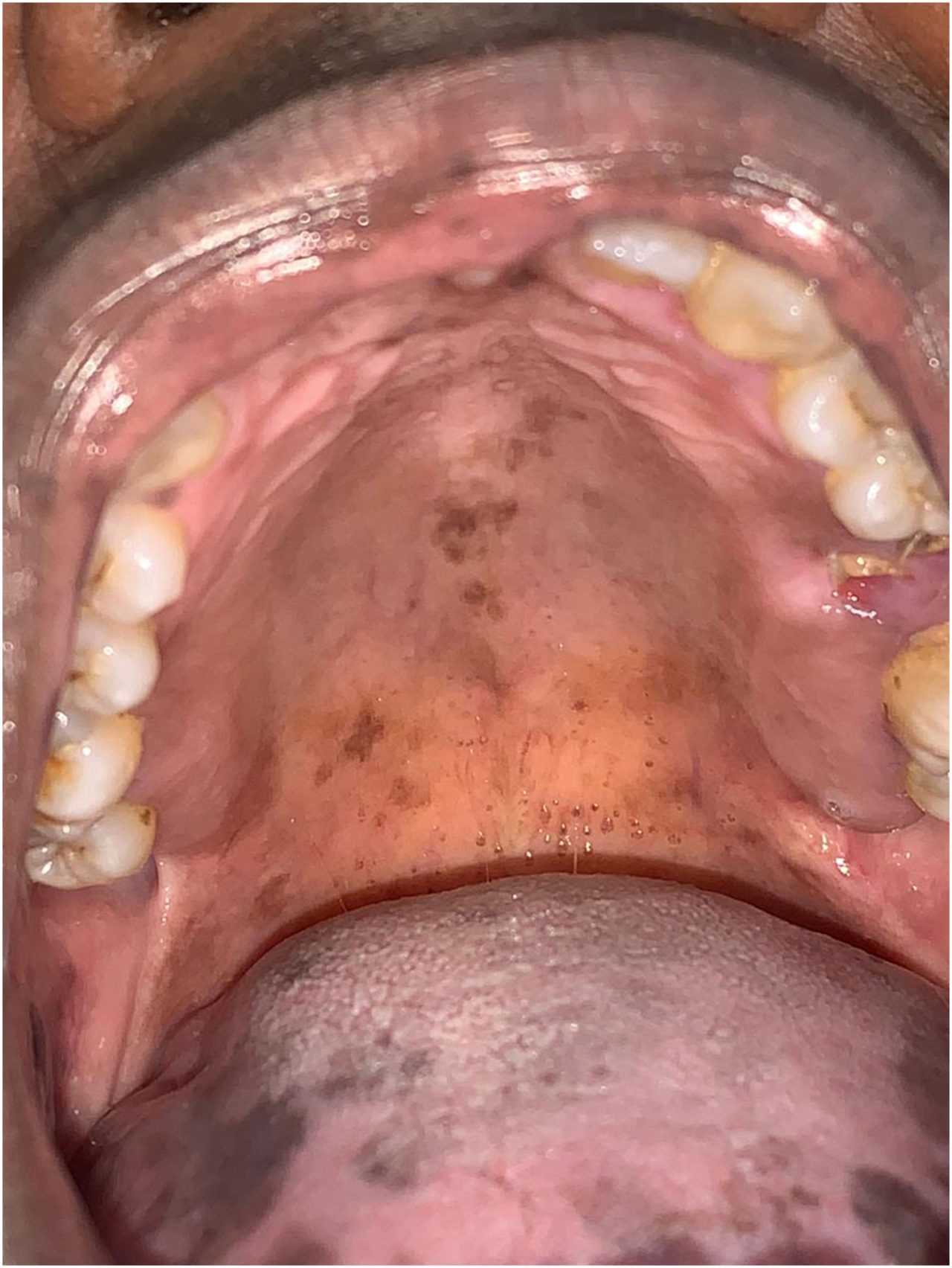 Manchas por todo céu da boca e língua do paciente por pigmentações medicamentosas;