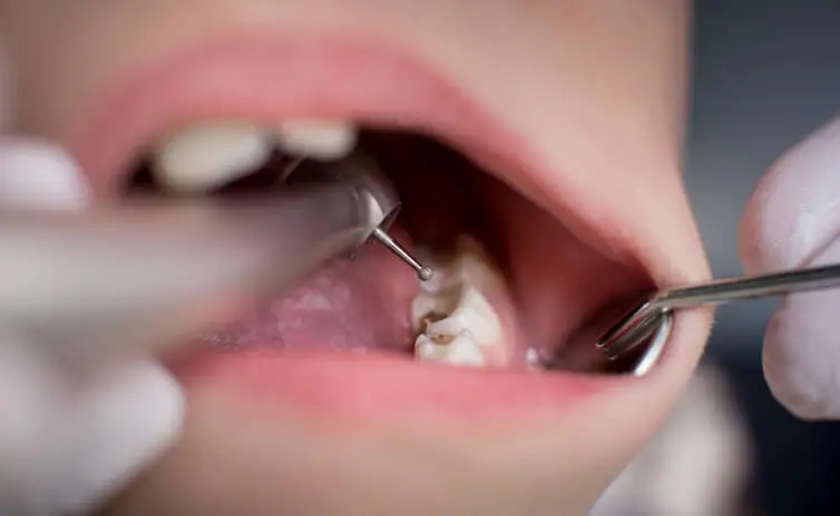 Dentista começara a realizar capeamento pulpar.