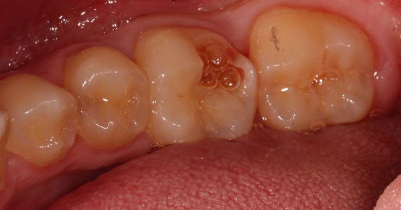 Antes de realizar capeamento no dente.