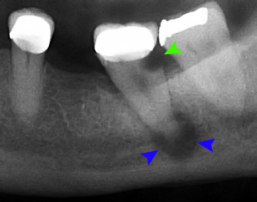 Raio-x de abscesso periapical.
