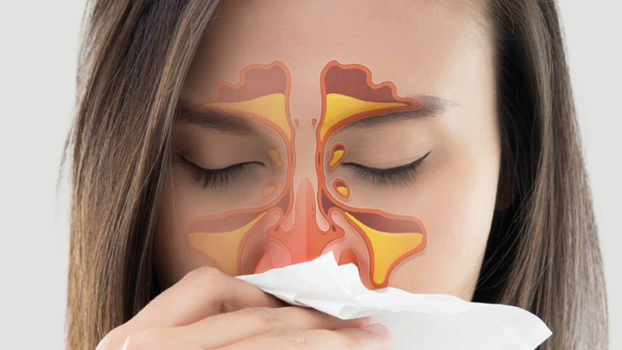 Mulher com rinite espirra em lenço. Em seu rosto tem desenho de como fica o nariz por dentro.