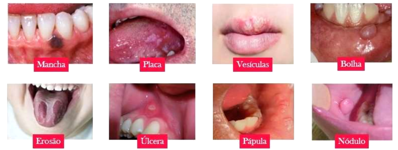 Diversos tipos de Lesões Fundamentais da Mucosa Oral lado a lado.