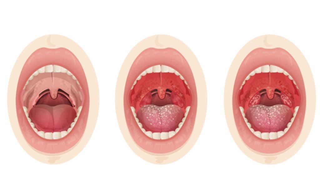 Desenho de boca sem e com amigdalite.