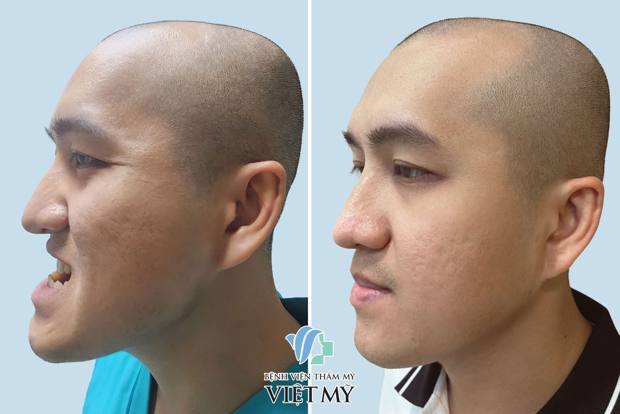 Antes e depois de homem vietnamita com prognatismo que passou por cirurgia e corrigiu.