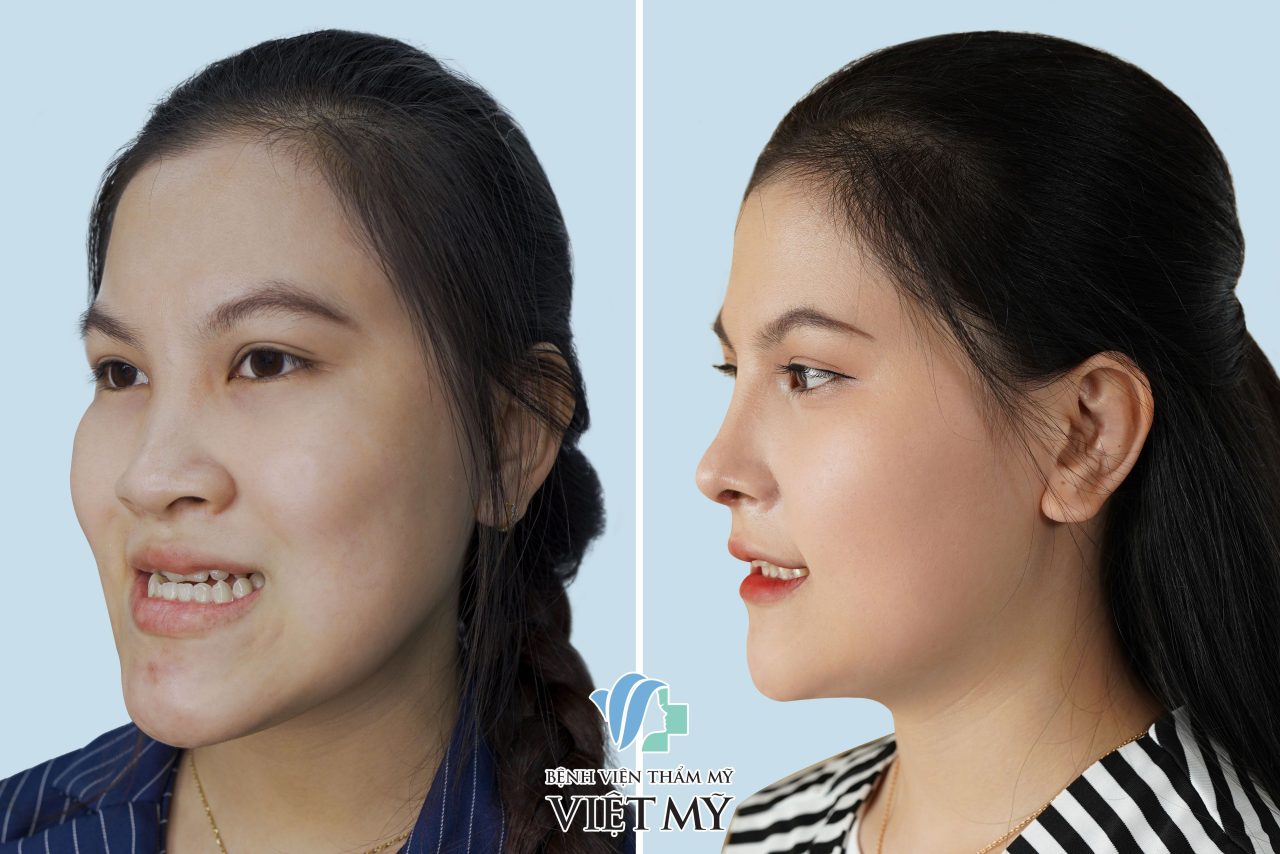 Antes e depois de mulher vietnamita com prognatismo que passou por cirurgia e corrigiu.
