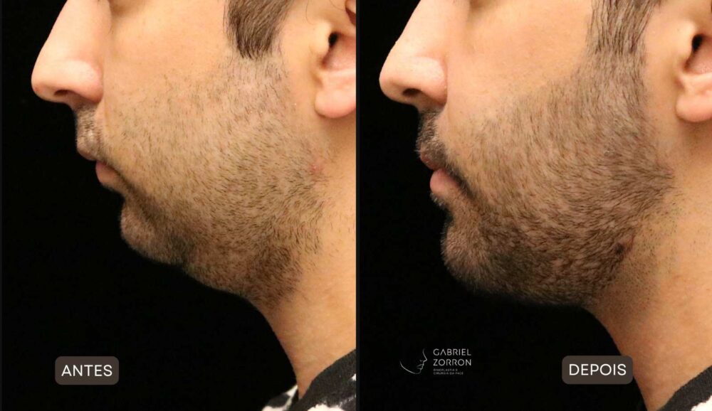 Antes e depois de homem com retrognatismo