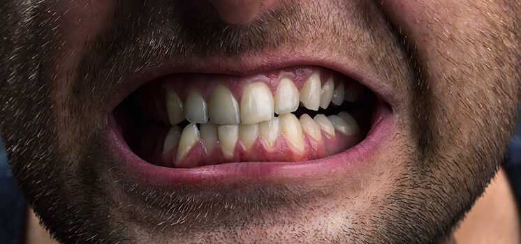 Homem rangendo os dentes demonstrando bruxismo.