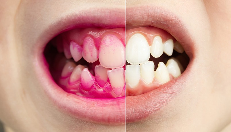 Imagem dividida entre os dentes do paciente com produto do protocolo gbt e o depois da limpeza;