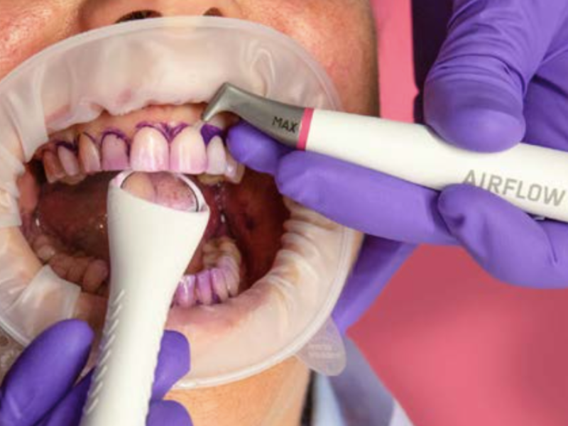 Dentista realizando protocolo gbt, removendo o biofilme.
