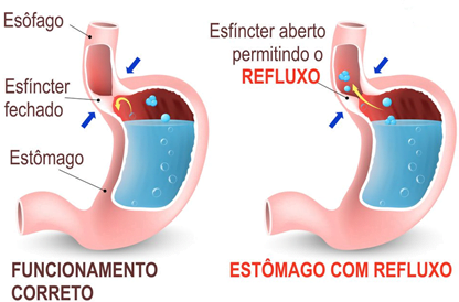 Desenho compara estômago sem e com refluxo.
