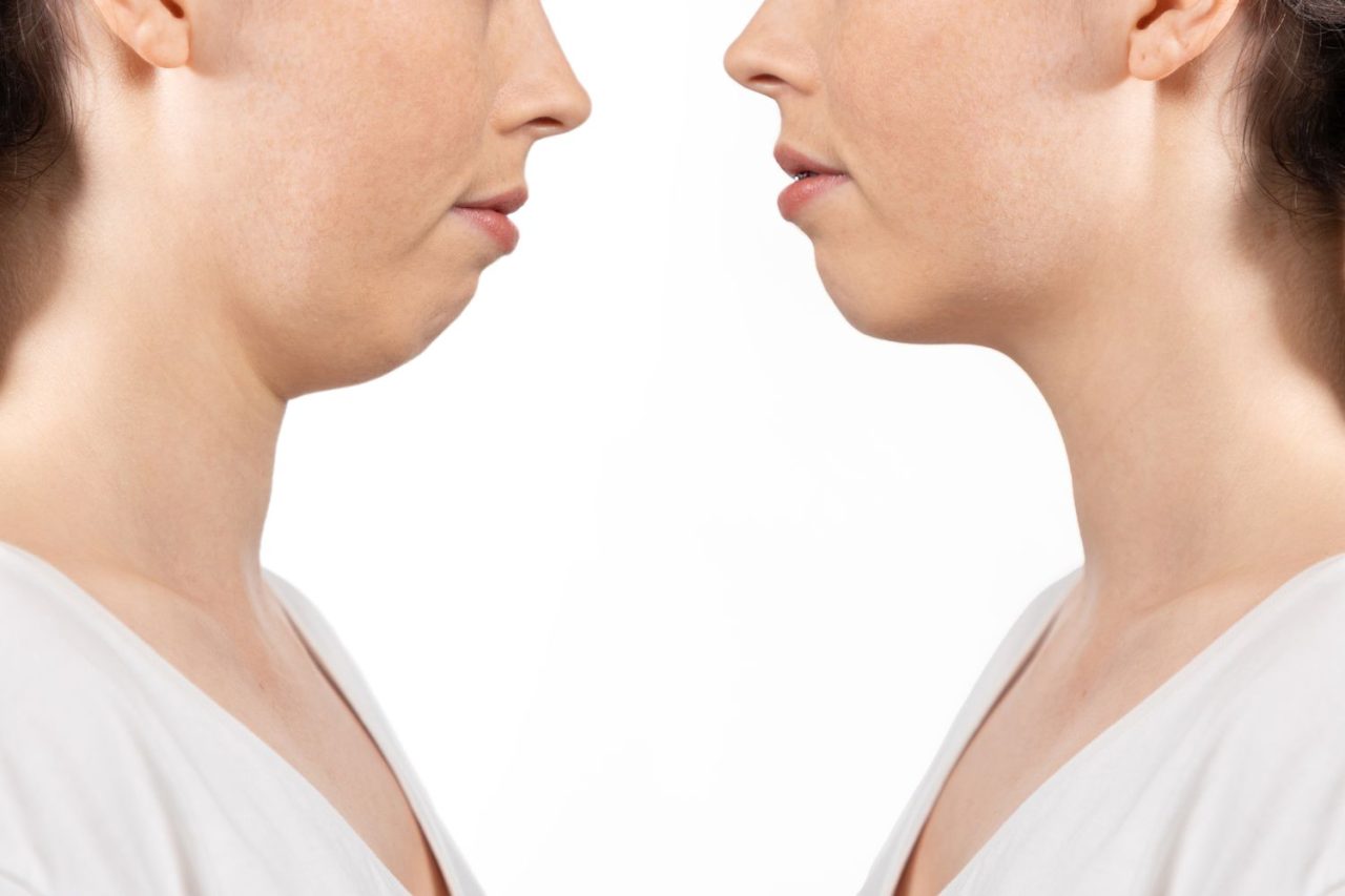 Antes e depois de mulher com retrognatismo