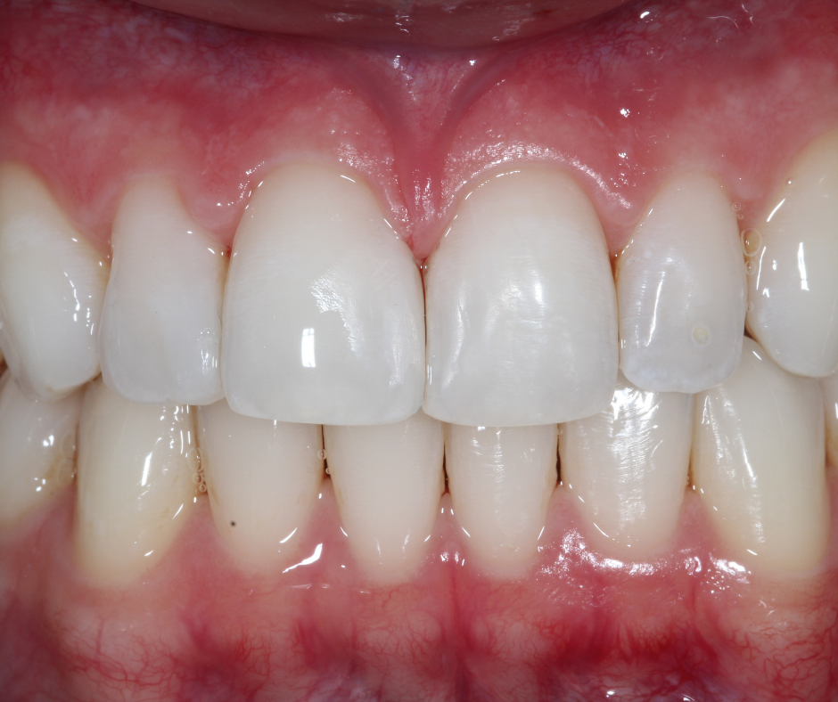 Após restauração com resina unicromática juntando o diastema.