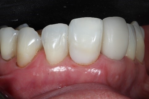 Dentes restaurados resinas unicromáticas.