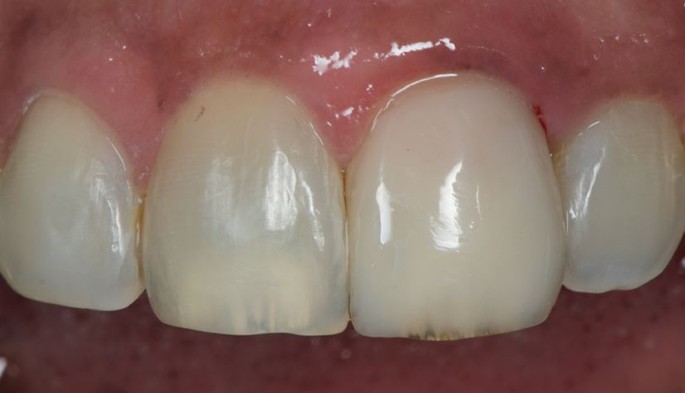 Dente restaurado com resina unicromática.