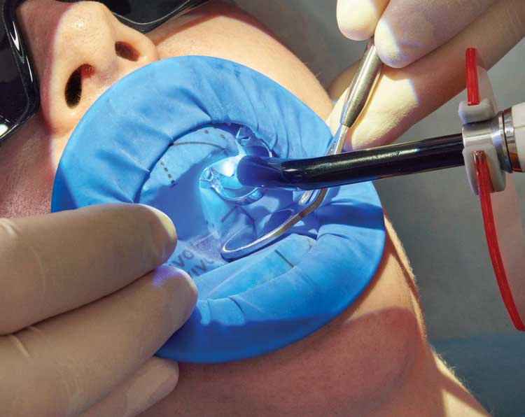 Dentista realizando restauração em dnete que está isolado.