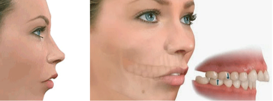 rosto de mulher desenhado de perfil com queixo retraído e do lado um zoom no dente mostrando com fica a mordida com retrognatismo