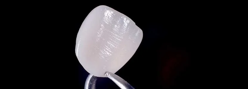 Dente de dissilicato de lítio.