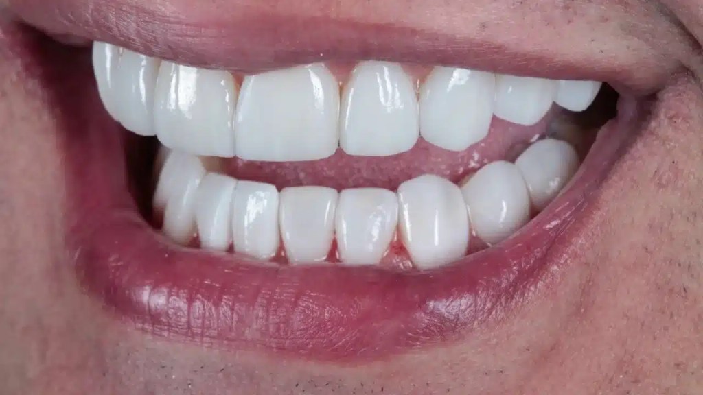 Pessoa sorrindo tem dentes de dissilicato de lítio.