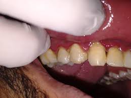 Dentista está puxando o lábio do paciente para mostrar sua gengivite necrosante.