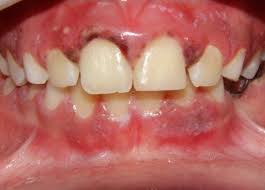 Boca de paciente com gengivite necrosante.