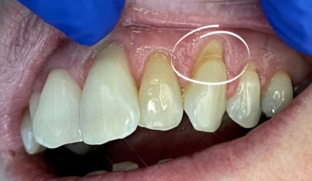Está circulado o dente com abfração dental